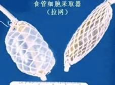 中国学者研发食管癌筛查新方法 “胶囊”采集细胞助患者早诊早治