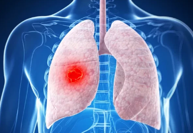 世卫：肺癌成为全球新增病例数最多癌症