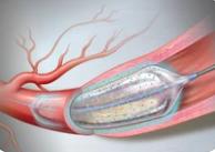 药物球囊有望代替支架治疗冠心病