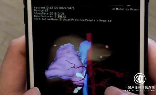 三维影像成外科医生“神器” 海信CAS助力根治高原“虫癌”