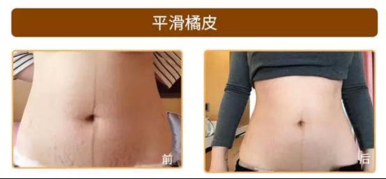 爱博恩医学护理·引领产妇瘦身新浪潮