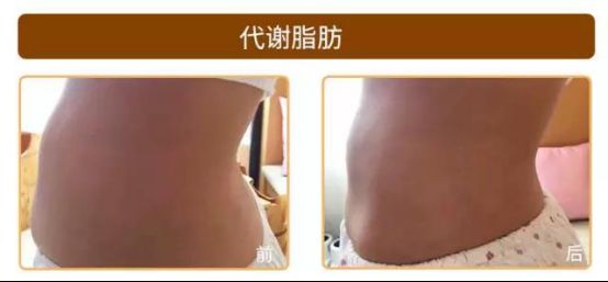 爱博恩医学护理·引领产妇瘦身新浪潮