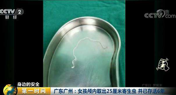 女孩颅内取出9厘米裂头蚴活虫 或与其爱吃青蛙和蛇有关