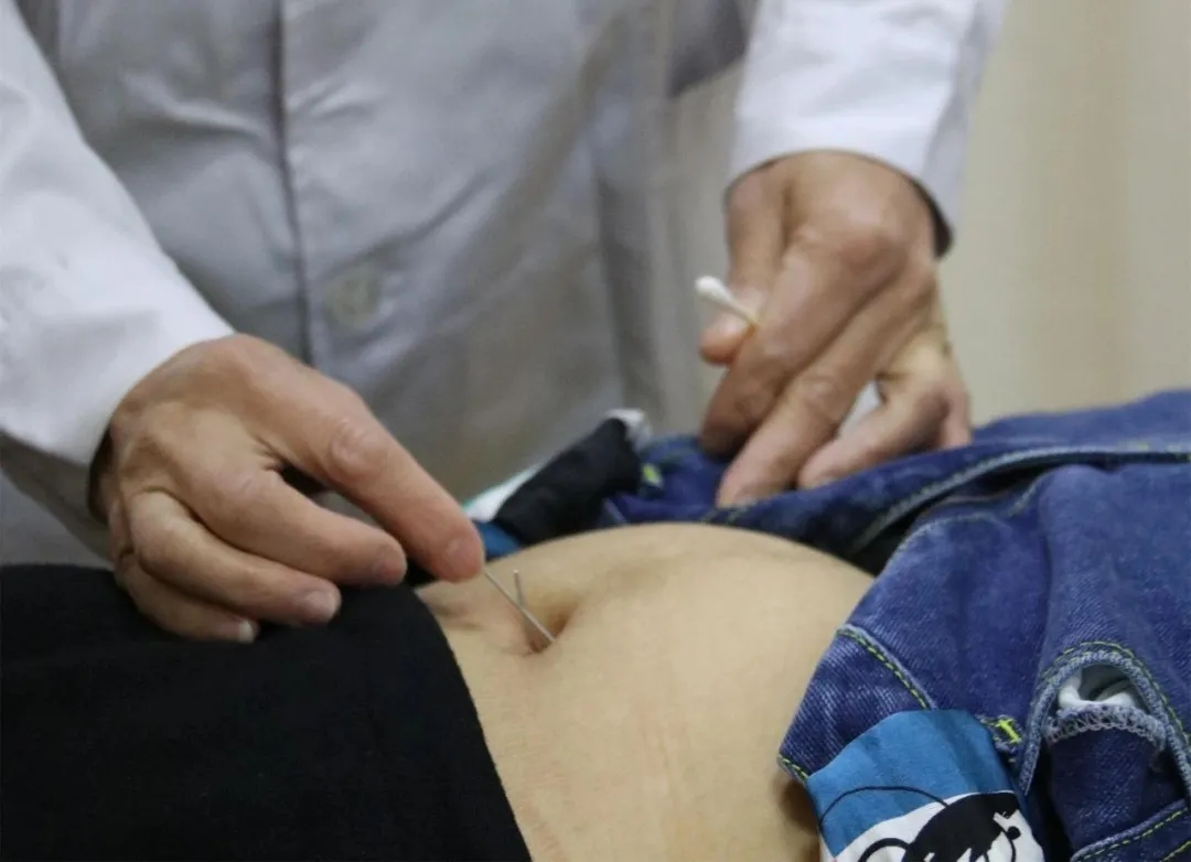 德州联合医院中医妇科 | 针刀速刺治疗腹型肥胖