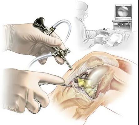 膝关节镜到底是什么，听德州市中医院骨伤科专家告诉您