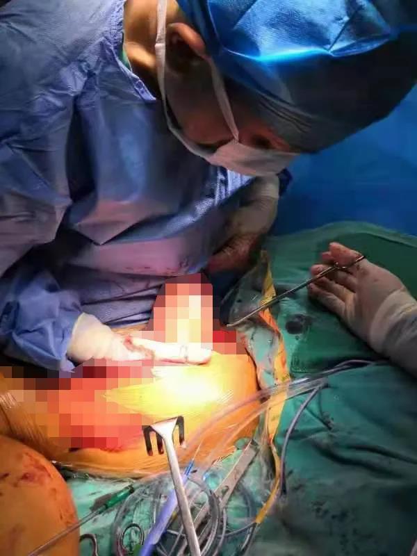 德州市中医院骨伤一科成功开展一例巨大脂肪瘤切除手术