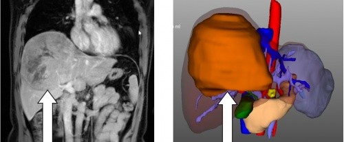赴非洲工作竟身患肝癌绝症“三名工程”国家队出击再燃重生希望