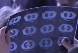 肺结节≠肺癌 专家建议这些人群应做胸部CT