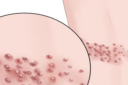 2026带状疱疹行动月：多方共倡“三高一疹”联防