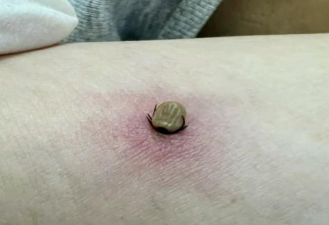 夏季蚊蜱等虫媒传染病风险显著上升 如何防范保安全？90秒快速了解！